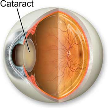 Cataract Services