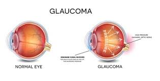 Glaucoma Services