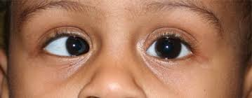 Pediatric Ophthalmology